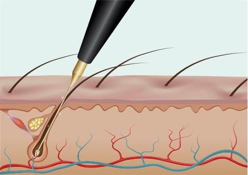 Electrolysis Picture