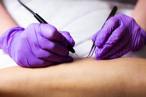 Electrolysis Picture